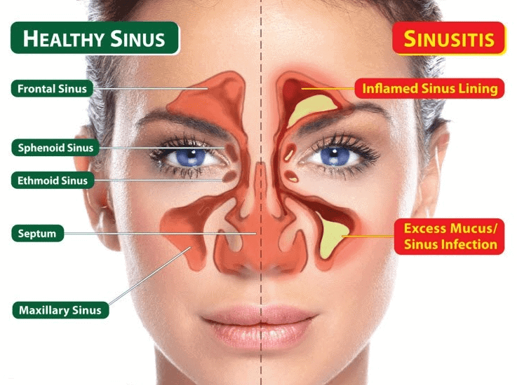 Sinusitis inflammation and terahertz - wellcare world - health - alternative medicine - terahertz sinusitis - terahertz